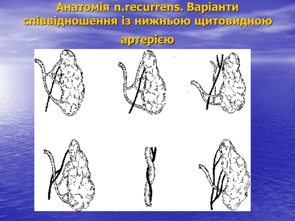 Анатомія n.recurrens. Варіанти співвідношення із нижньою щитовидною артерією